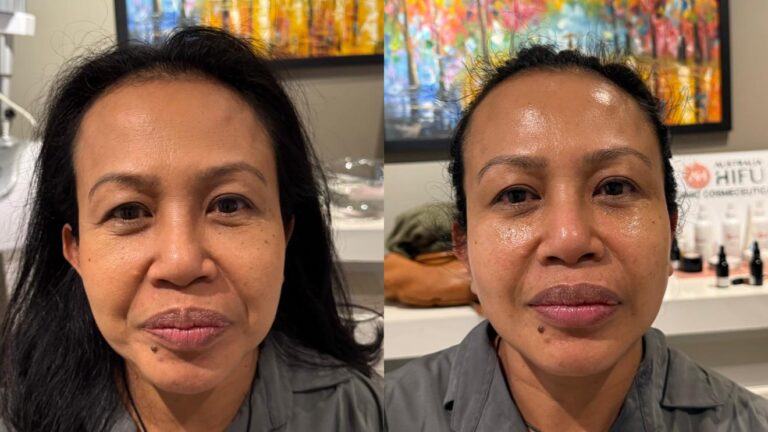 hifu-treatment-sydney