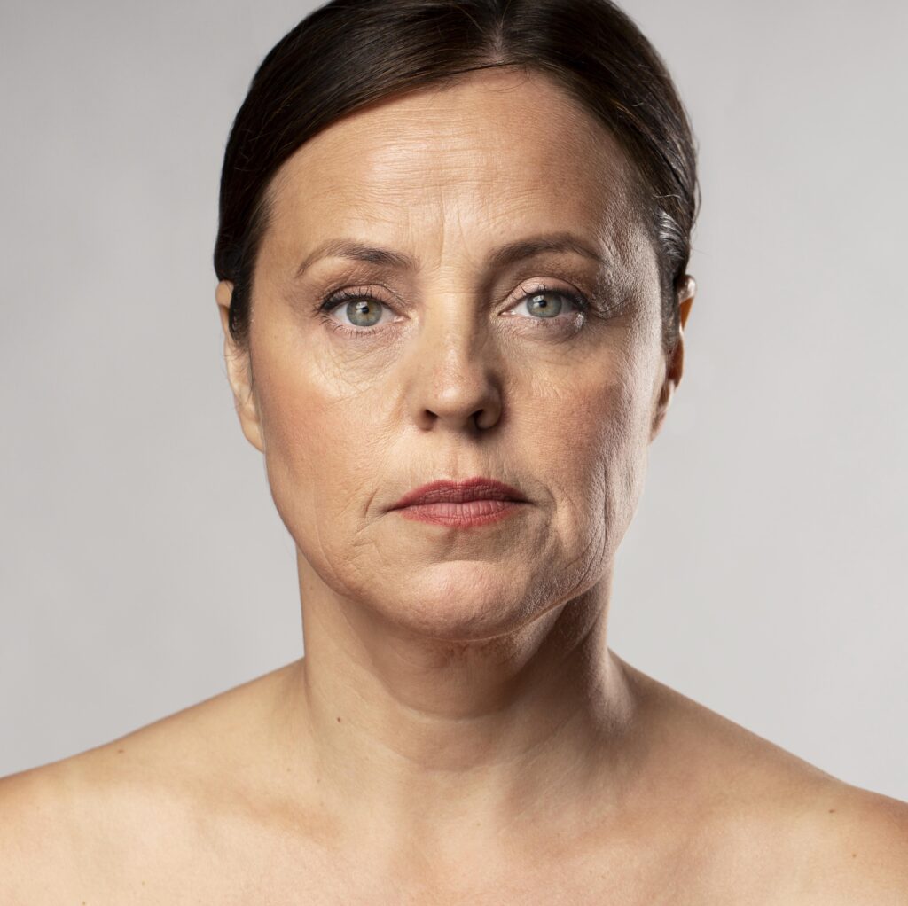 profhilo-treatment-before-after
